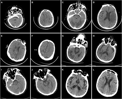 Neurological Manifestations in Critically Ill Patients With COVID-19: A Retrospective Study